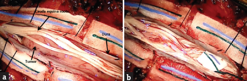 Intraoperative pictures showing before (a) and after (b) gross total resection