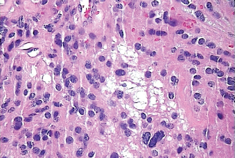 Vacuolated Cells on Hematoxylin and Eosin Stain at 400x