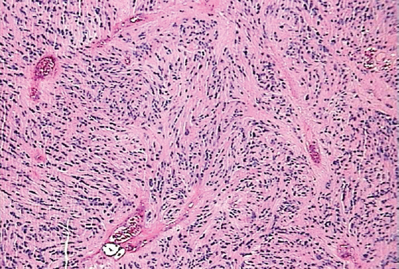 Inconspicuous Pseudorosettes on Hematoxylin and Eosin Stain at 100x