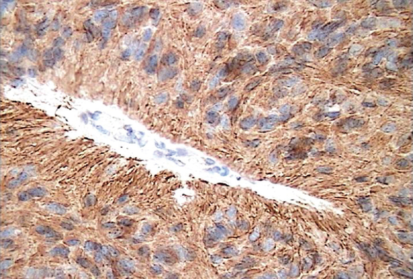 Glial Fibrillary Acidic Protein Stain on Immunohistochemical Stain at 400x