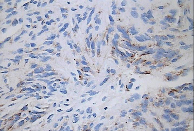 Epithelial Membrane Antigen Stain on Immunohistochemical Stain at 200x