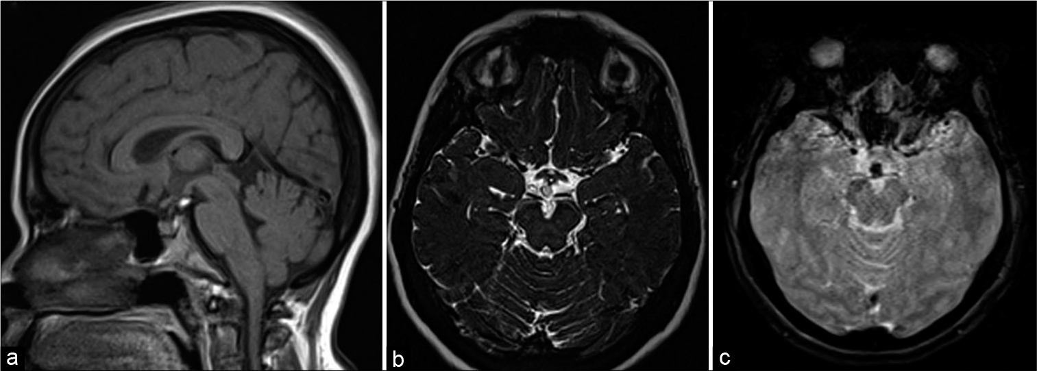 A 46-year-old female with headache. T1-weighted sagittal (a), heavily T2-weighted SPACE axial (b), and gradient-echo GRE T2* axial images showing small speck of fat in suprasellar cistern just posterior to infundibular stalk showing susceptibility effect in (c).