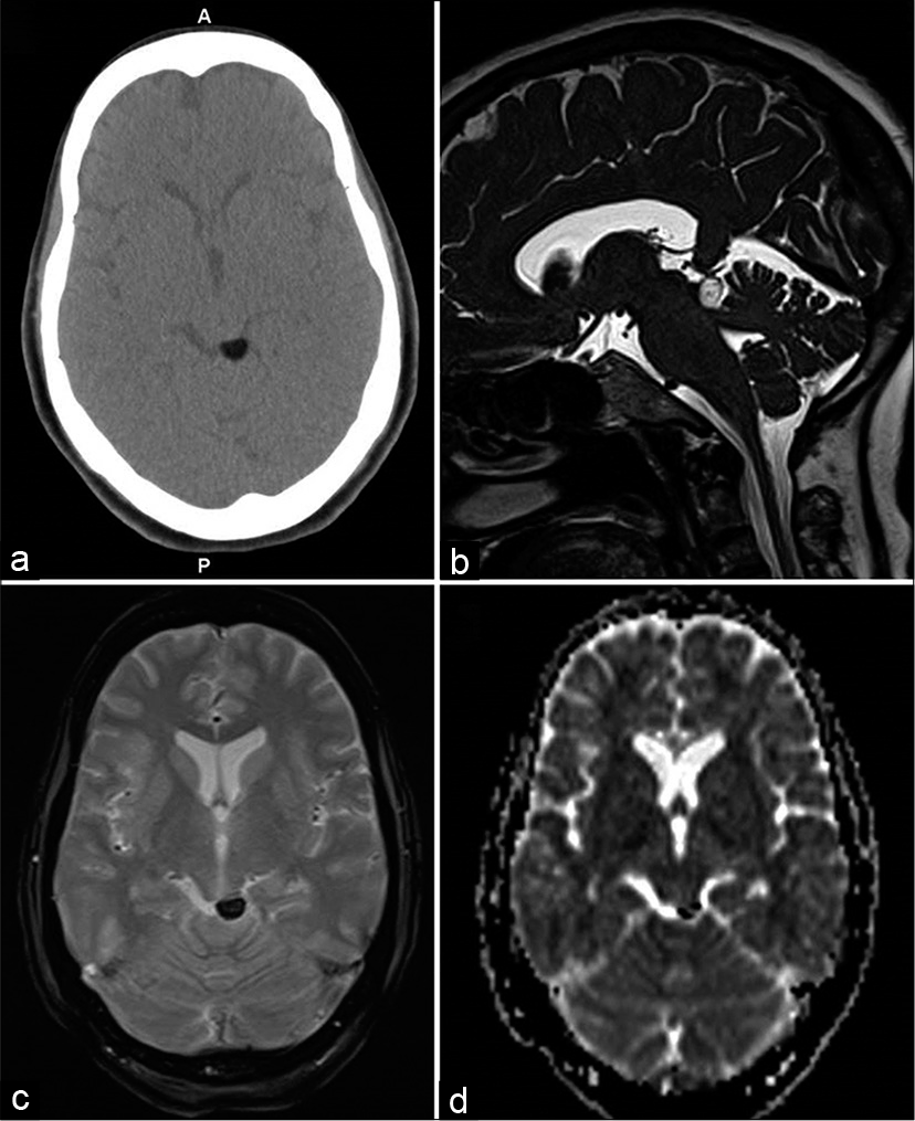 A 48-year-old female with the left facial and neck pain. Axial CT (a), heavily T2-weighted SPACE sagittal (b), gradient-echo GRE T2* axial (c), and diffusion ADC image (d) showing focal lipomas in left quadrigeminal plate cistern with susceptibility effect in (c and d).