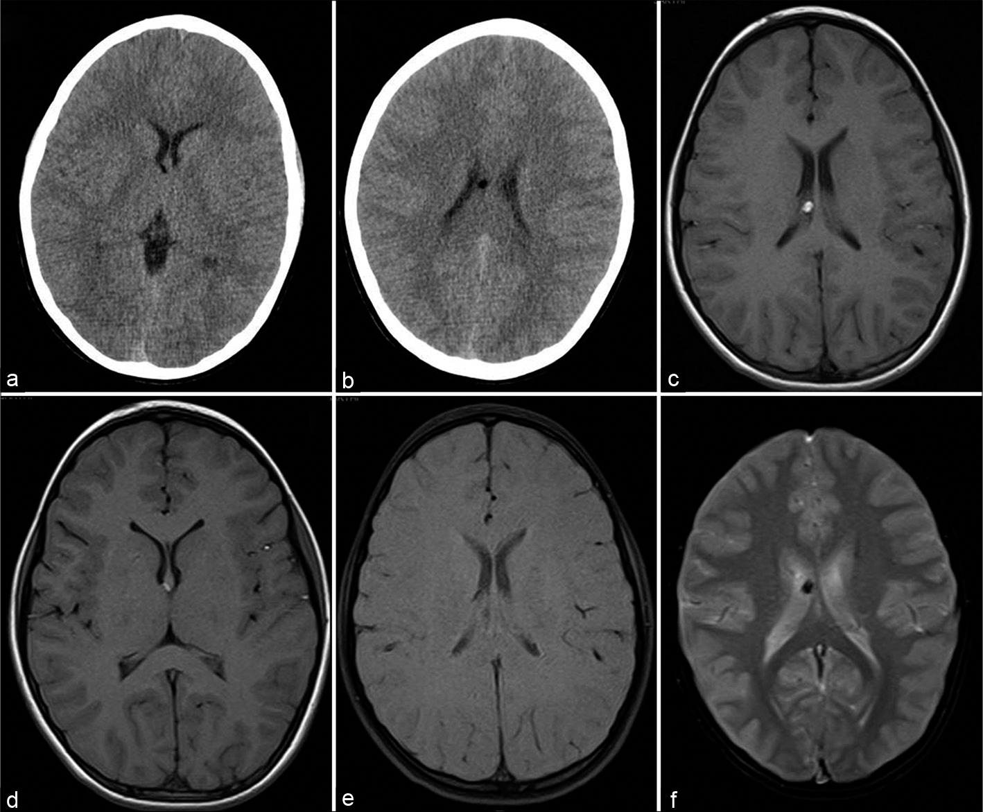 A 12-year-old boy asymptomatic CT axial sections at ventricular level (a and b), T1-weigted axial (c and d), T1 with fat saturation (e), and gradient-echo GRE T2* axial (f) sections showing small fat specks along the right fornix with susceptibility effect.