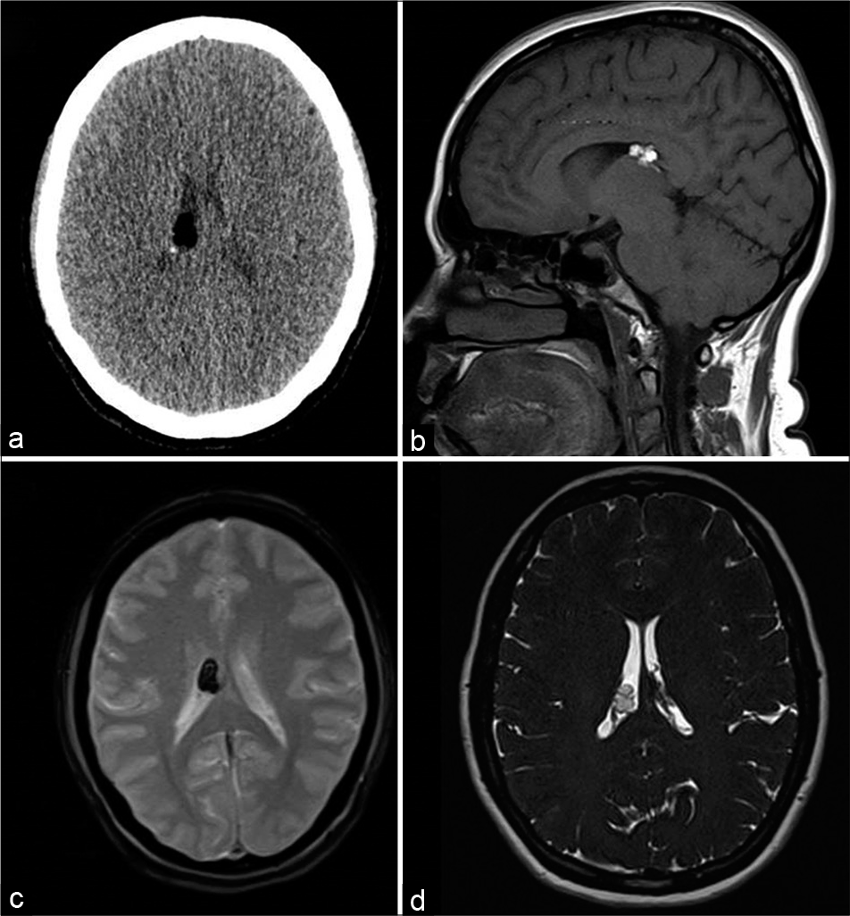 A 39-year-old female with headache. Axial CT (a), T1-weighted sagittal (b), gradient-echo GRE T2* axial (c), and heavily T2-weighted SPACE axial (d) images showing lipoma along the choroid plexus of the right lateral ventricle with susceptibility effect (hypointensity in c).