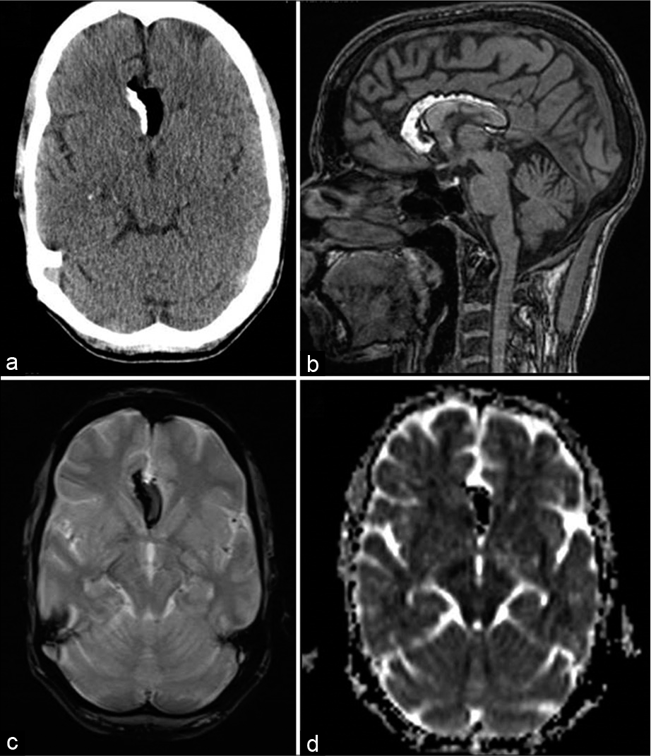 A 45-year-old female with headache. Axial CT (a), T1-weighted sagittal, gradient-echo GRE T2* axial (c), and diffusion (ADC axial images showing partly-calcified pericallosal lipomas with susceptibility effects (c and d).