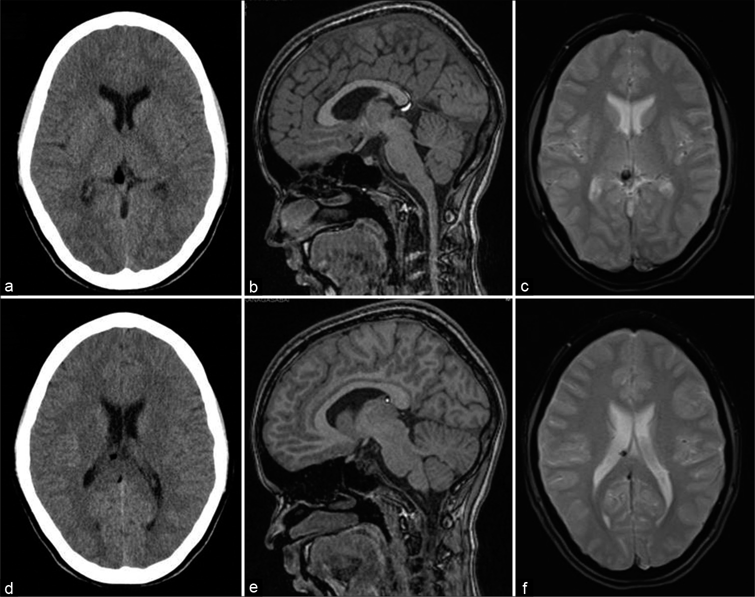 A 13-year-old female with headache. Axial CT (a and b), T1-weighted sagittal (c and d), and gradient-echo GRE T2* axial (e and f) images showing small fat specks in the cistern of velum interpositum along the anterior end of the right fornix and just inferior to splenium of corpus callosum with susceptibility effects.