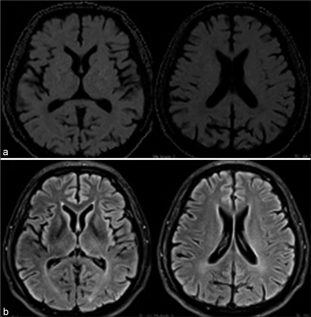 Magnetic resonance imaging of the head, with diffusion-weighted imaging (a) and fluid attenuated inversion recovery (b) sequence, showing no lesion of stroke.