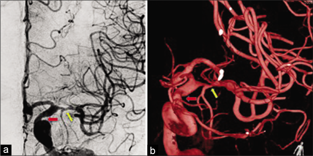 Results of cerebral catheter angiography (a) and three-dimensional reconstruction (b) showing 70% stenosis of the M1 segment of the left middle cerebral artery (yellow arrow), 30% stenosis of the left supraclinoid ICA (red arrow).