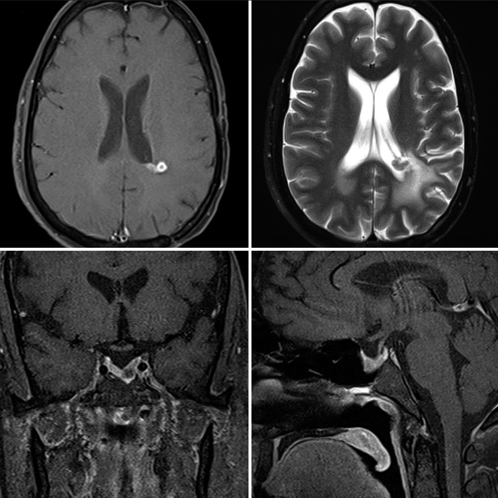 Synchronous presentation of prolactinoma and supratentorial tanycytic ...