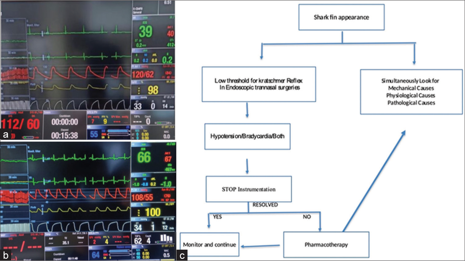 (a) Shows hemodynamics during the event, (b) shows hemodynamics before extubation, (c) shows approach to shark fin appearance.