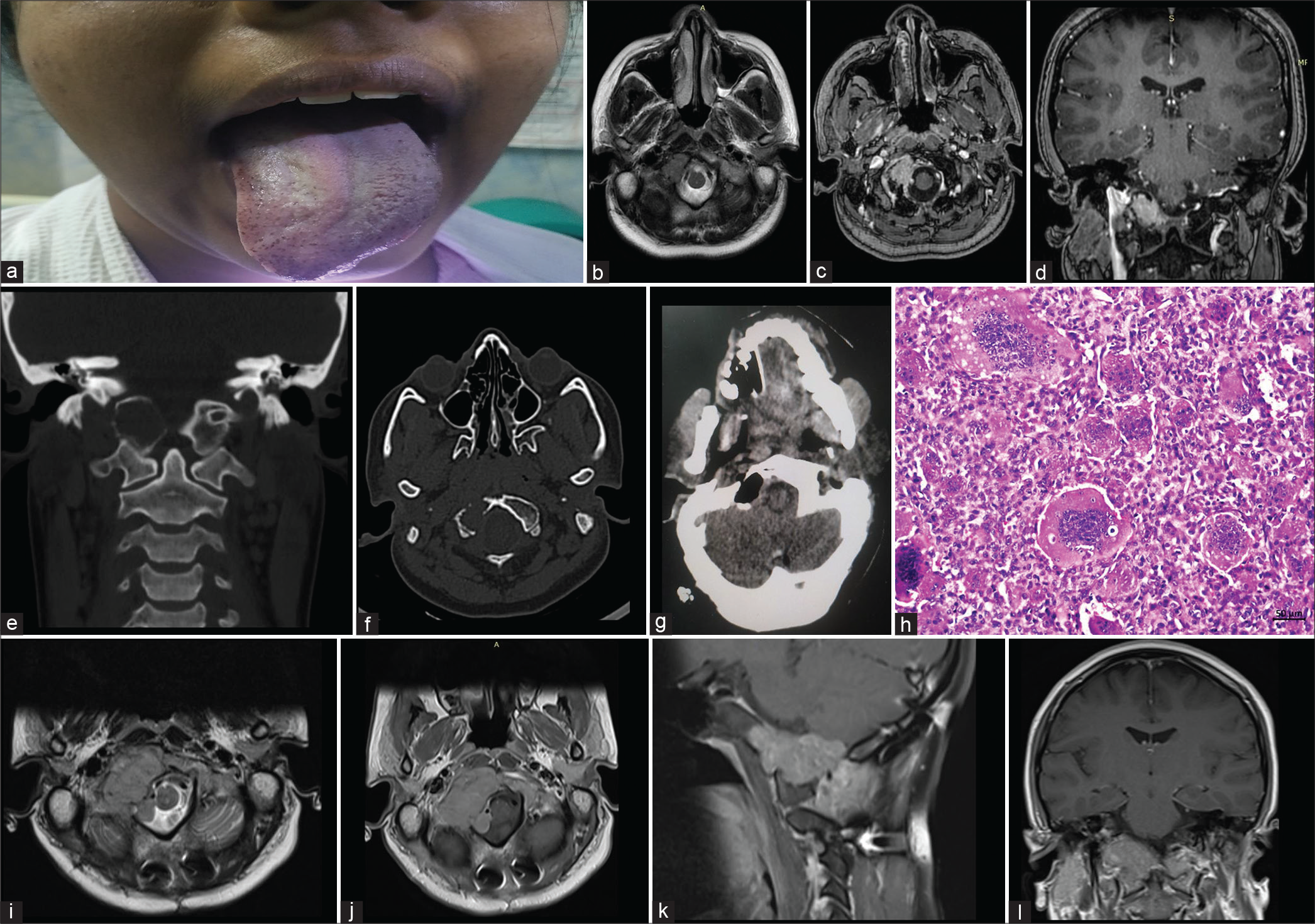 (a) Clinical picture showing right LMN hypoglossal palsy, (b) pre-operative magnetic resonance imaging (MRI) T2 axial images showing hypointense right occipital condylar lesion, (c and d) post-contrast images showing enhancing mass in the right occipital condyle (axial and coronal respectively), (e and f) coronal and axial computed tomography image showing the lesion, (g) post-operative cavity and excision of the right occipital condyle lesion, and (h) tumor comprising mononuclear stromal cells interspersed with osteoclast-like giant cells (hematoxylin and eosin, original magnification ×200 and scale bar 50 μm). (i) Axial T2 MRI showing large hypointense recurrence in the right occipital condylar region and (j-l) post-contrast MRI showing moderately enhancing large recurrent lesion in axial, sagittal, and coronal planes, respectively.