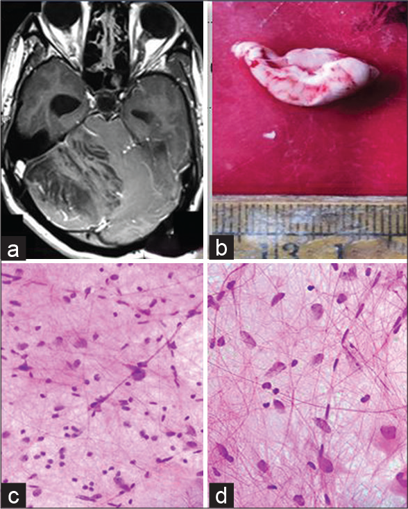 (a) MRI-T1 weighted MRI of the brain showing a hyperintense lesion of right cerebellar hemisphere with striated folial pattern or tiger-striped appearance, (b) Gross-Enlarged cerebellar folia, (c) (squash cytology, H&E x 400) - scattered, enlarged cells with vesicular nuclei and prominent nucleoli against a fibrillary background, (d) (squash cytology, H&E x 400) - Thickened axons and capillary sized vessels.