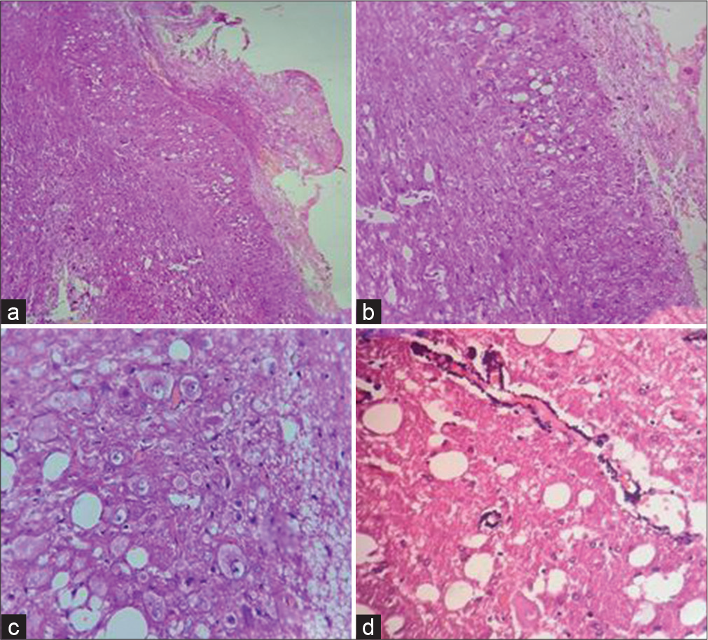 (a) H&E x40, (b) (H&E x100) - Show enlarged cerebellar folia with vacuolation of molecular and granular layer and loss of Purkinje cells, (c) (H&E x100) - aggregates of dysplastic neurons in molecular and granular layer, (d) (H&E x400) - Shows calcified vessel wall and vacuolation in background.