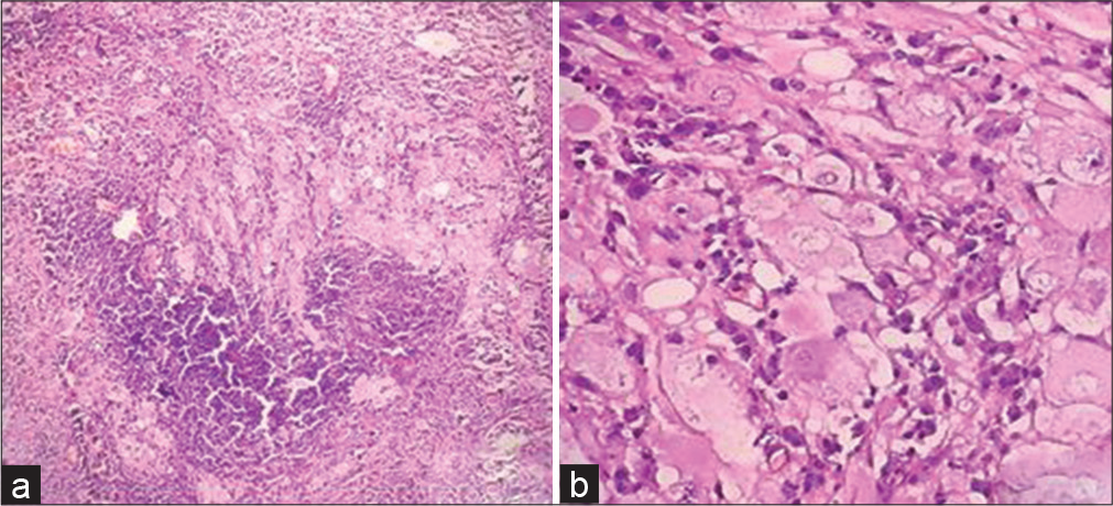 (a) (H&E x100) - Shows aggregates of large dysmorphic neurons admixed with dense inflammation predominantly plasma cells, (b) (H&E x400) - show numerous dysplastic ganglion cells.