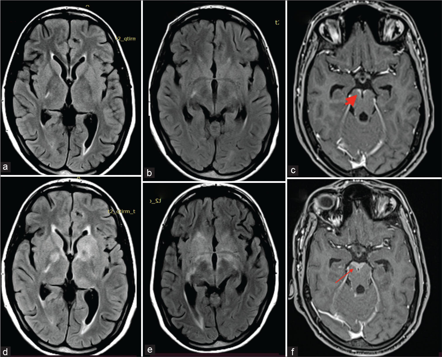 (a-f) The first neuroimaging (FLAIR a and b) does not reveal any significant signal changes. Note is made of contrast enhancement anterior to the midbrain on T1 post-contrast (c) (thick arrow). Second neuroimaging (FLAIR d and e) shows extensive hyperintensities in bilateral basal ganglia region. There is also increase in the contrast enhancement in the midbrain on T1 post-contrast (f) (thin arrow). FLAIR: Fluid-attenuated inversion recovery.