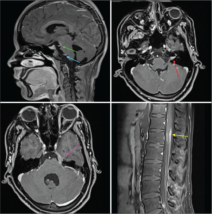 T1 post-contrast images. Green and blue arrows show 3rd and 6th cranial nerve enhancement, respectively; red arrow shows enhancement of 7th and 8th cranial nerves in the left internal auditory meatus. Pink arrow shows contrast enhancement of 5th cranial nerve, while the yellow arrow shows nodular contrast enhancement in D12–L1 region.