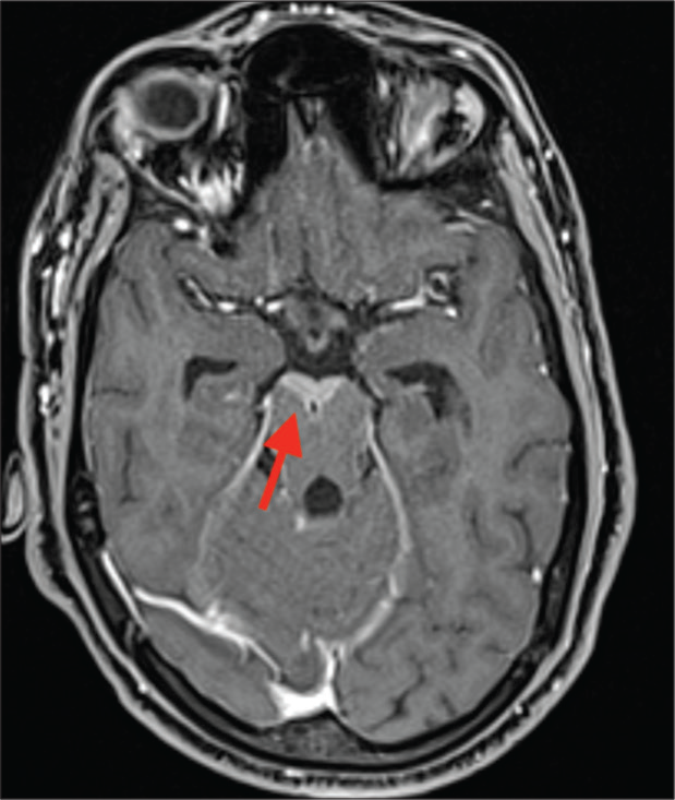 T1 Post-contrast image showing contrast enhancement anterior to the midbrain (red arrow).