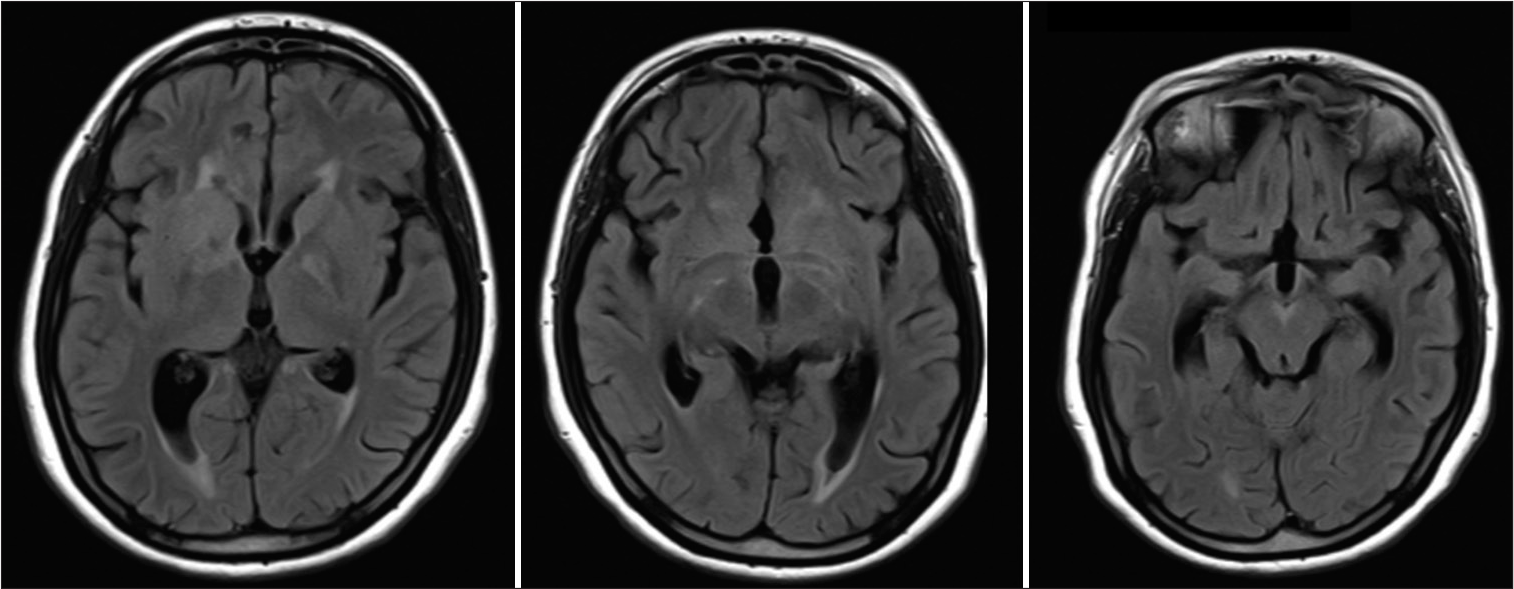 Fluid-attenuated inversion recovery images 2 weeks post-treatment showing resolution of the previous changes.