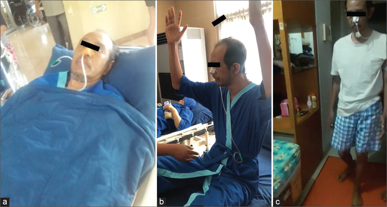 The first patient when undergone hyperbaric therapy (a), 2nd day (b), 10th day (c), 20th day.