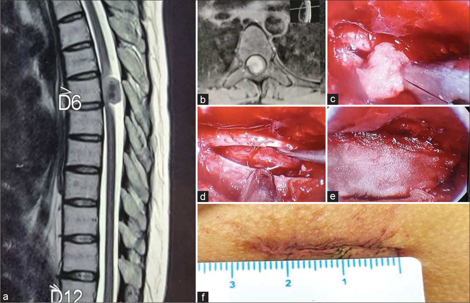 (a) T2-weighted magnetic resonance imaging (MRI), sagittal section, showing well-defined ventrally placed intradural extramedullary lesion at D6 vertebral body level. (b) T1-weighted contrast-enhanced MRI, axial section, showing a homogeneous contrast-enhancing IDEM lesion. (c) Intraoperative image: Tumor excision. (d) Dural opening with cord seen within. No residual tumor is seen. (e) Artificial dura was placed over the dural defect. (f) Sutured incision (2.5 cm).