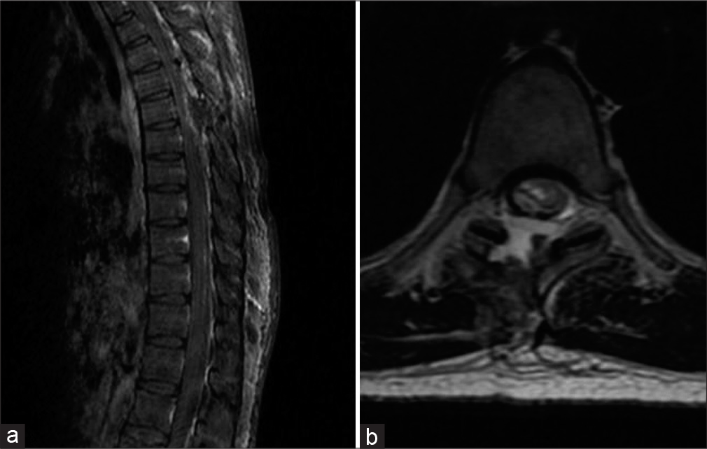 Immediate post-operative MRI of the patient with D6 vertebral body level meningioma. (a) T1 sagittal contrast-enhanced MRI. (b) T2 axial MRI.