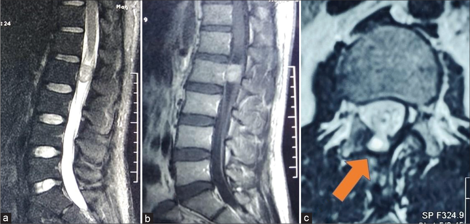 (a) Pre-operative image – T2 sagittal MRI showing heterogeneous, dominantly isointense IDEM lesion at L2 level. (b) Pre-operative image – T1 sagittal contrast-enhanced MRI showing homogenously contrast-enhancing IDEM at the L2 level. (c) Post-operative image – T2 axial image at L2 vertebral body level showing pseudomeningocele (arrow) herniating through the hemilaminectomy defect. The overlying muscle planes are well maintained.