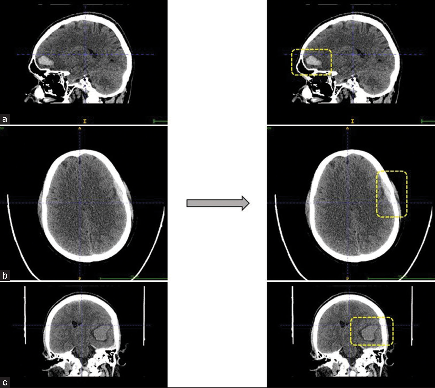 Predicted intracranial hemorrhage bounded by the boxes. (a and c) are intraparenchymal hemorrhages seen in sagittal and coronal view, respectively. Whereas (b) is example for microsubdural hemorrhage seen in axial view.