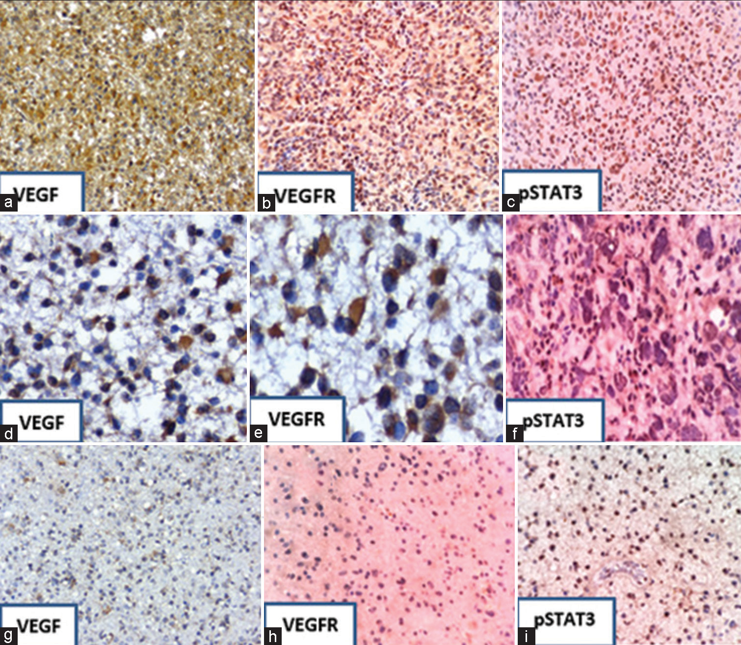 Immunohistochemical staining showing the expression of VEGF, VEFGR, and pSTAT3; Strong expression (a-c) in GBM (Grade IV) and from (d-f) moderate expression in anaplastic astrocytoma (Grade III). From (g-i), there is a weak expression of markers in diffuse astrocytoma (Grade II). Immunostaining is also seen in endothelial cells (f and i). Magnification ×200. VEGF: Vascular endothelial growth factor, VEGFR: Vascular endothelial growth factor receptor, and pSTAT3: Phosphorylated signal transducer and activator of transcription factor 3.