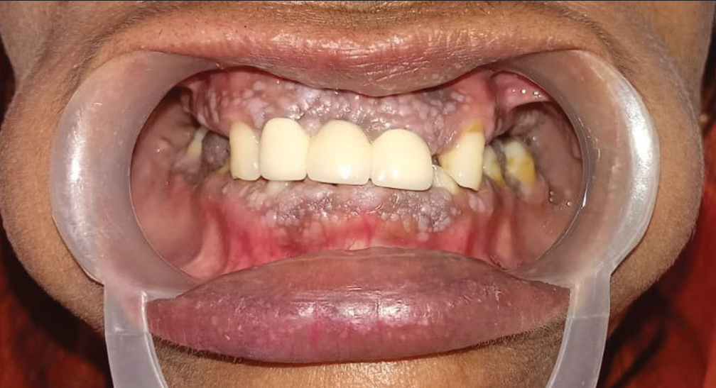 Intra-oral picture showing cobblestone appearance on gingiva.