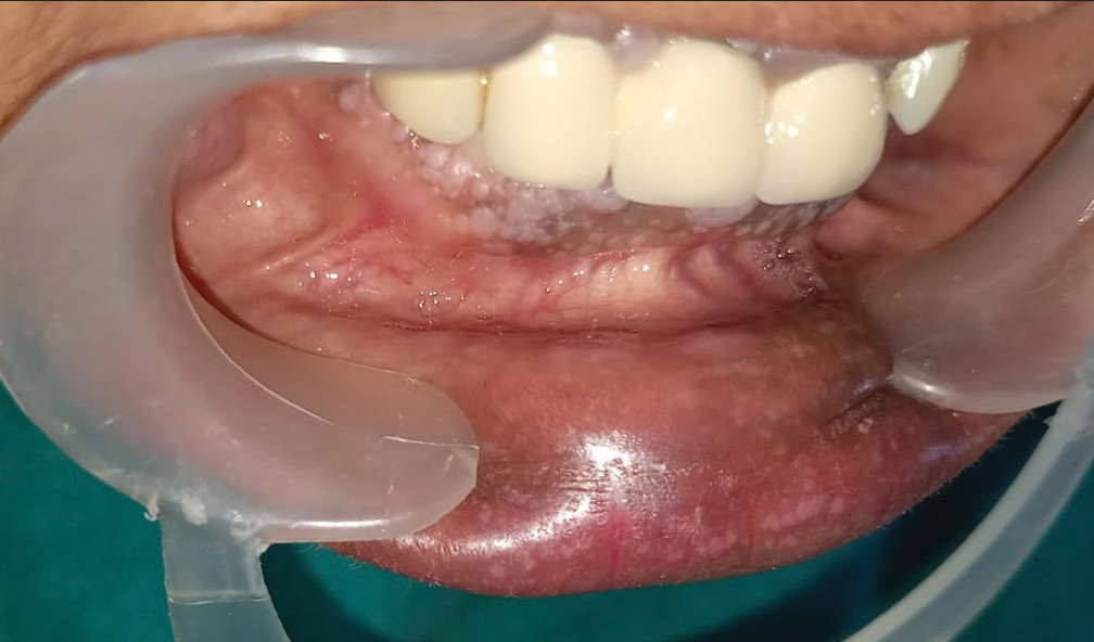 Intra-oral picture showing cobblestone appearance on the lower labial mucosa.