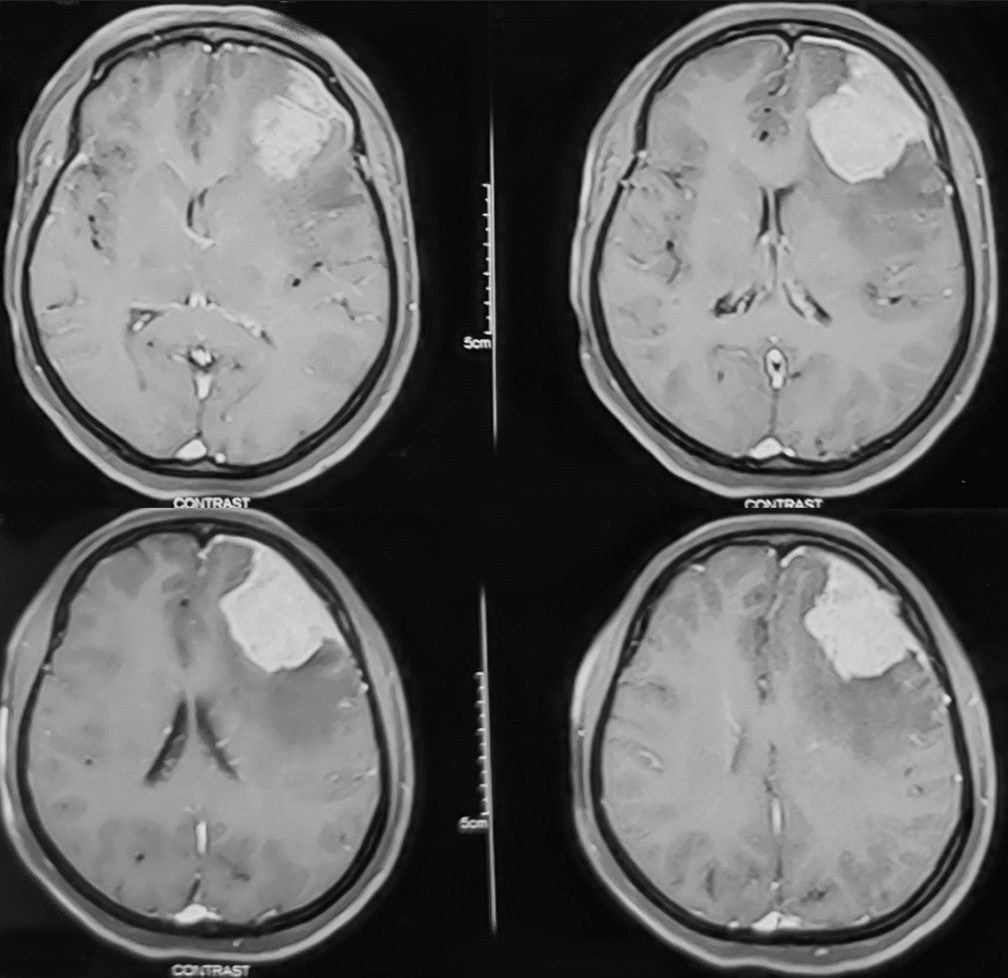 Magnetic resonance imaging brain showing an extra-axial homogenously enhancing lesion in the right frontal region suggestive of meningioma.