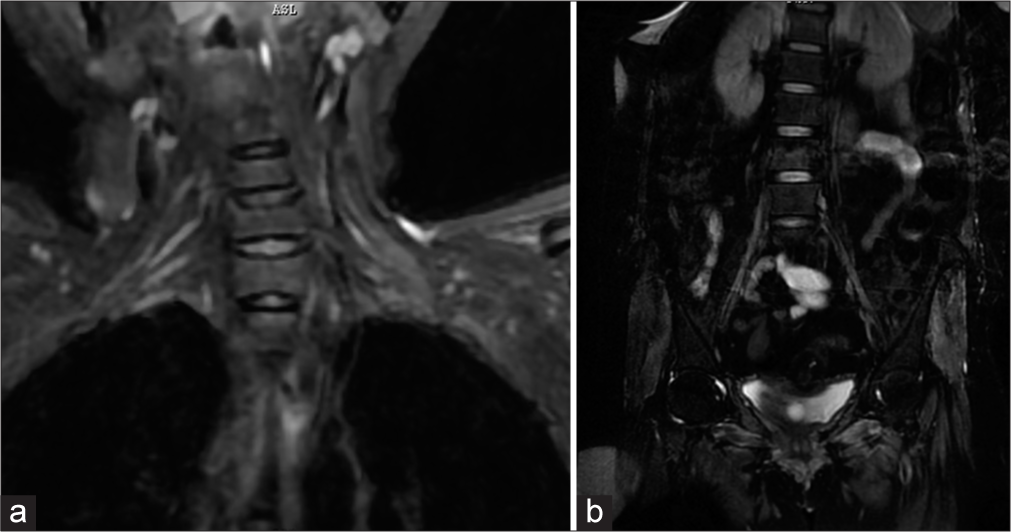 Magnetic resonance imaging short tau inversion recovery coronal images showing (a) Thickening and hyperintense change of bilateral cervical roots (Left>Right) and (b) Thickening and hyperintense signal change in bilateral lumbosacral roots.