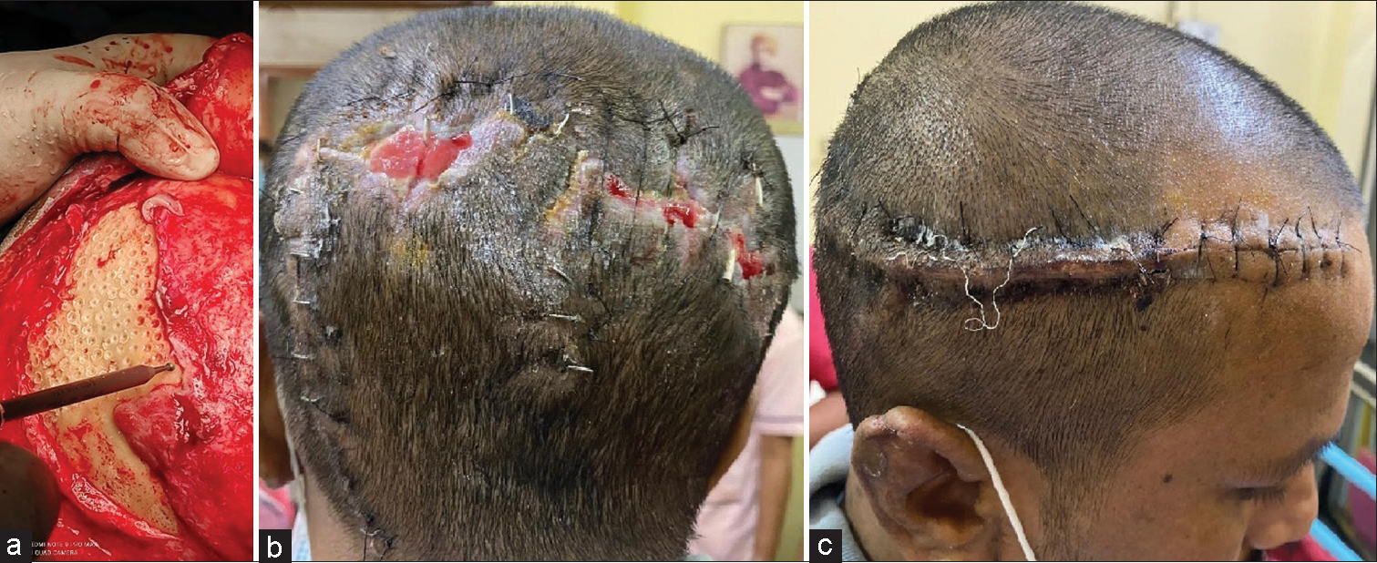 Operative photograph showing (a) multiple calvarial drillings of the outer cortex to expose the diploe being done with a high-speed drill; (b) wound covered and healing satisfactorily with few areas of granulation tissue and no exposed bone with healing of the posterior flap incision and (c) healing of the anterior flap incision.