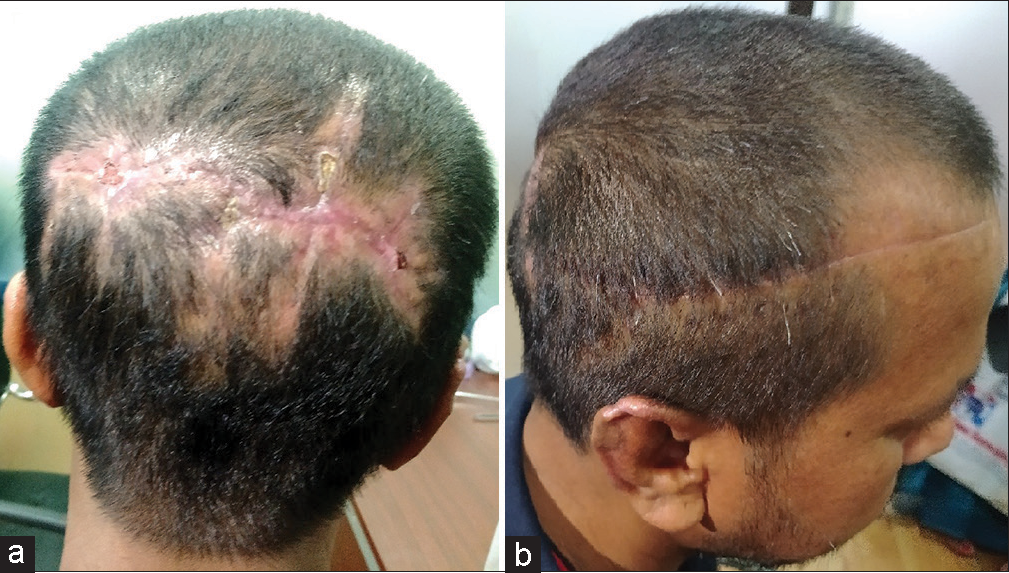 Clinical photographs 1 month later (a and b) showing the wound with small areas of scab and satisfactory hair growth over most of the previously exposed area.