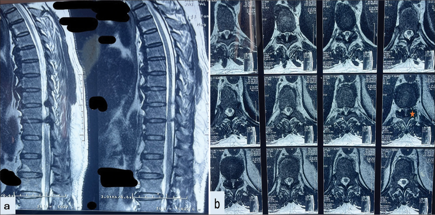 Magnetic resonance imaging (MRI) of patient with dorsal hypertrophied ligamentum flavum (a) MRI sagittal T2-weighted image shows a beak-like projection of hypertrophied ossification of the ligamentum flavum (OLF) causing compression over the cord with associated cord signal changes. (b) MRI axial T2-weighted image showing compression of dorsal hypertrophied OLF (shown in star).