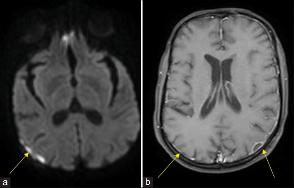 Magnetic resonance imaging brain contrast: (a) Small epidural collection in left parieto-occipital region and right frontoparietal convexity with restricted diffusion suggestive of empyema. (b) Pachymeningeal enhancement along left frontoparietooccipital convexity with leptomeningeal enhancement.