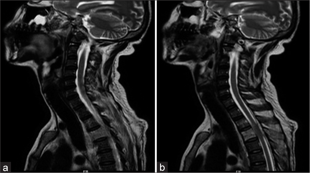 (a) Magnetic resonance imaging (MRI) cervical and upper thoracic spine: Infective spondylitis D2-D3 level with large perivertebral soft tissue component. (b) MRI cervical and upper thoracic spine: Soft tissue around D3 showing peripheral enhancement suggestive of liquified abscess.