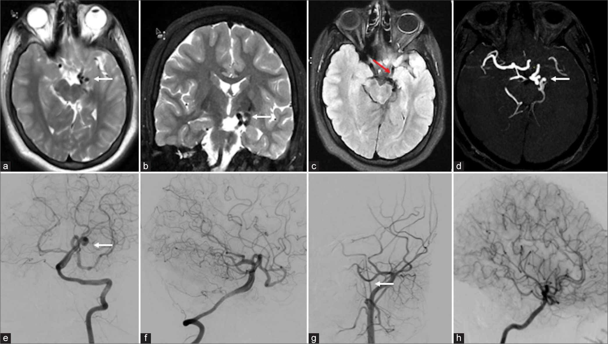 (a-d) Magnetic resonance imaging (MRI) and digital subtraction imaging showed the imaging features of pure arterial malformation (PAM) MRI image: (a) Axial T2, (b) coronal T2, and (c) axial fluid-attenuated inversion recovery showed abnormal coiled-like vessels in the left side of the suprasellar cistern (white arrows) with dysplastic left hippocampus and medial temporal lobe (red arrow). (d) Time-of-flight circle of Willis showed coiled-like vessels in the left posterior cerebral artery (PCA) without abnormal veins (white arrow). (e-h) Digital subtraction angiography image: (e and f) Vertebral artery runs showed coiled-like vessels in the left PCA without abnormal draining vein (white arrow). (g) The left common carotid artery run showed non-visualization of the left internal carotid artery (ICA) from bifurcation and continued as an ascending pharyngeal artery (white arrow). (h) The right ICA run showed multiple leptomeningeal collaterals in the right cerebral parenchyma.
