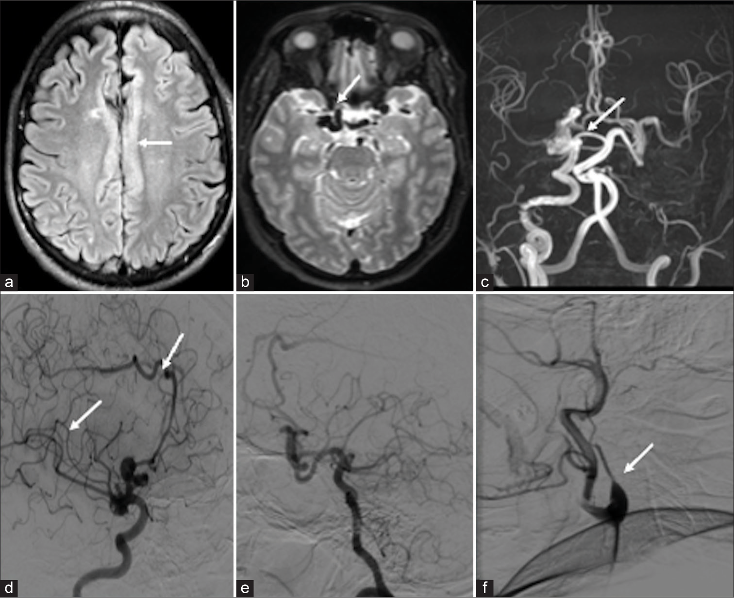 (a-c) Magnetic resonance imaging (MRI) digital subtraction imaging showed the imaging features of pure arterial malformation (PAM) MRI image: (a) Axial fluid-attenuated inversion recovery showed pachygyria over the cingulate cortex (white arrow), (b) axial T2 image showed multiple abnormal dilated vessels in the right supraclinoid internal carotid artery (ICA) (white arrow), and (c) time-of-flight circle of Willis showed dilated right supraclinoid ICA and right pericallosal artery without abnormal veins and non-visualization of the left ICA (white arrow). (d-f) Digital subtraction angiography image: (d) Right common carotid artery (CCA) lateral showed abnormally dilated arteries in the right supraclinoid ICA, pericallosal artery with aneurysm, without abnormal draining vein (white arrow). (e) The right vertebral artery showed multiple collaterals and filling of the left middle cerebral artery through the left posterior communicating artery. (f) The left CCA run showed non-visualization of the left ICA from bifurcation and continued as ascending pharyngeal artery (white arrow).