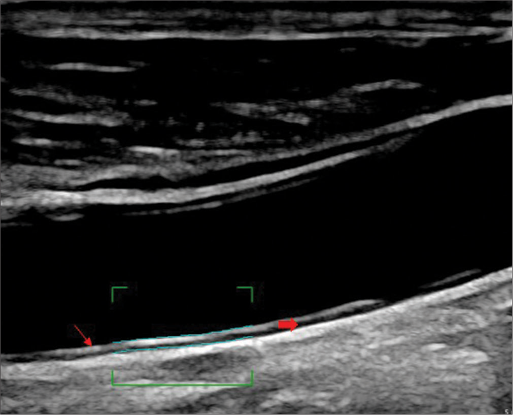 Measurement of carotid intima-media thickness (CIMT) in distal wall of the common carotid artery (line arrow shows the tunica adventitia and block arrow shows the tunica intima-media, wavy lines within the bracket indicate automated CIMT measurement).