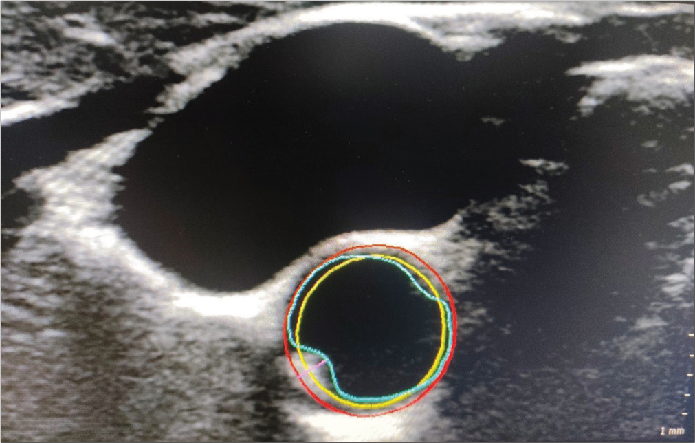 Carotid plaque detection in vascular plaque quantification mode using key frame. (Red: Outer vessel wall, Yellow: Inner vessel wall, Blue: Lumen-intima interface, Pink: Plaque thickness).