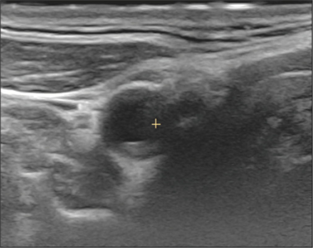 3D cross-sectional image of carotid bifurcation showing a smooth plaque with mixed echogenicity.