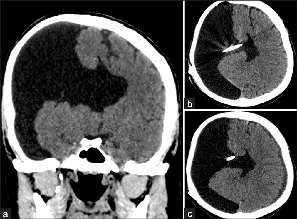 (a) Computed tomography (CT) scan showing large subdural collection on the right side with open-lip schizencephaly; (b) post-operative CT scan showing the tip of shunt in ventricle; and (c) follow-up CT scan showing a reduction in right subdural collection and appearance of thin subdural hygroma on the left side.