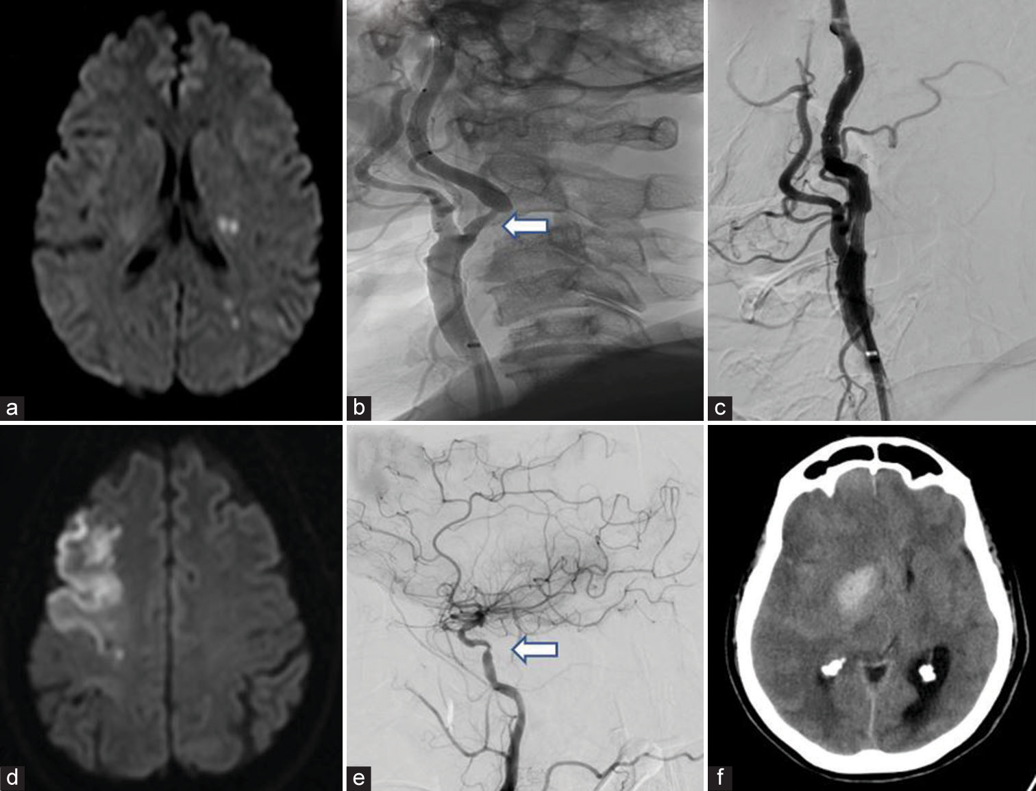 (a) Mixed infarct-Left middle cerebral artery (MCA) TI with MCA- posterior cerebral artery border zone infarct, (b) Pre-stenting digital subtraction angiography (DSA) showing severe >70% stenosis (white arrow), (c) Post-stent deployment DSA showing no residual stenosis, (d) territorial infarct in right MCA, (e) DSA showing tight stenosis of right internal carotid artery (white arrow), (f) Cerebral hyperperfusion syndrome – Basal ganglia hemorrhage with mass effect and vasogenic edema in same patient post-stenting.