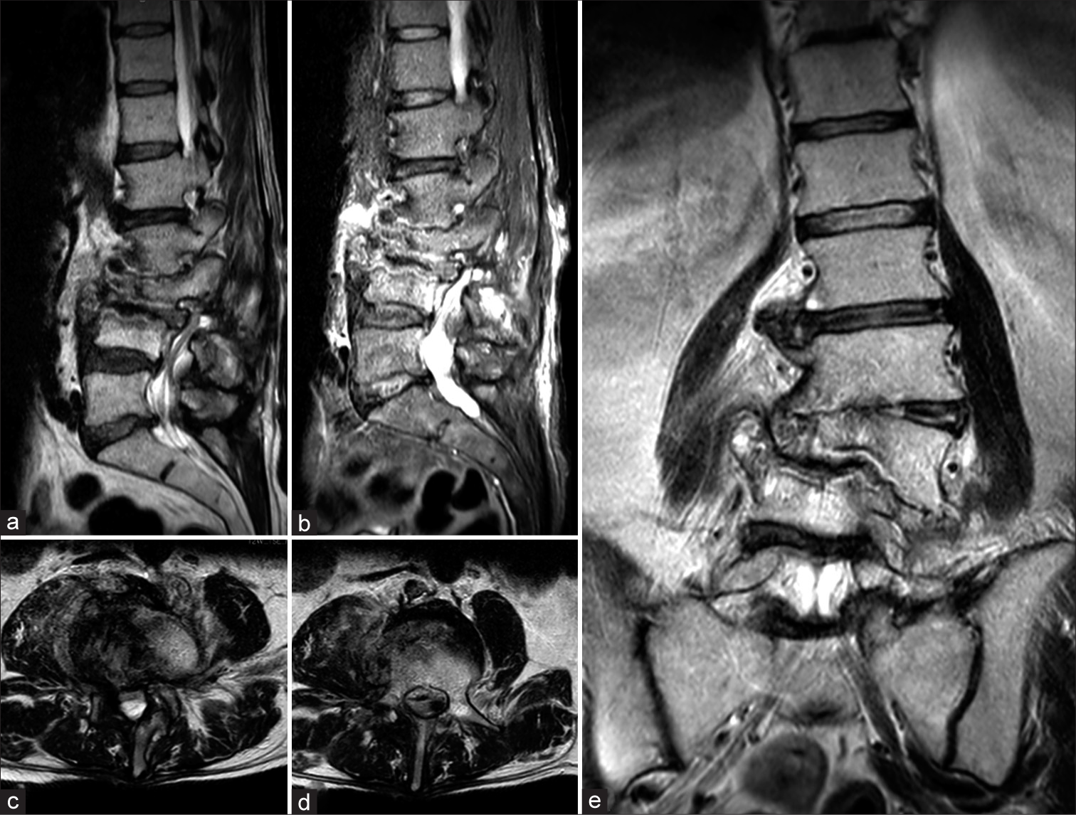 (a) Sagittal T2 and (b) short T1 inversion recovery (STIR)-weighted images showing hyperintensity of L2, L3, and L4 with alteration of vertebral bodies. (c and d) Axial T2-weighted images showing hyperintensity of the right iliopsoas and of the vertebral body of L4. (e) Coronal T2-weighted view showing L3 collapse with complete disruption of L2-L3 and L3-L4 discs.