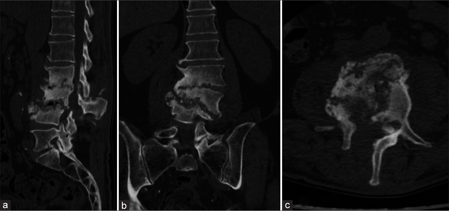 (a) Sagittal, (b) coronal, and (c) axial post-operative computed tomography scans of the patient affected by Parvimonas micra-related spondylodiscitis, showing complete structural alteration of L2, L3, and L4 and the presence of laminectomy, as shown in the (c) axial view.