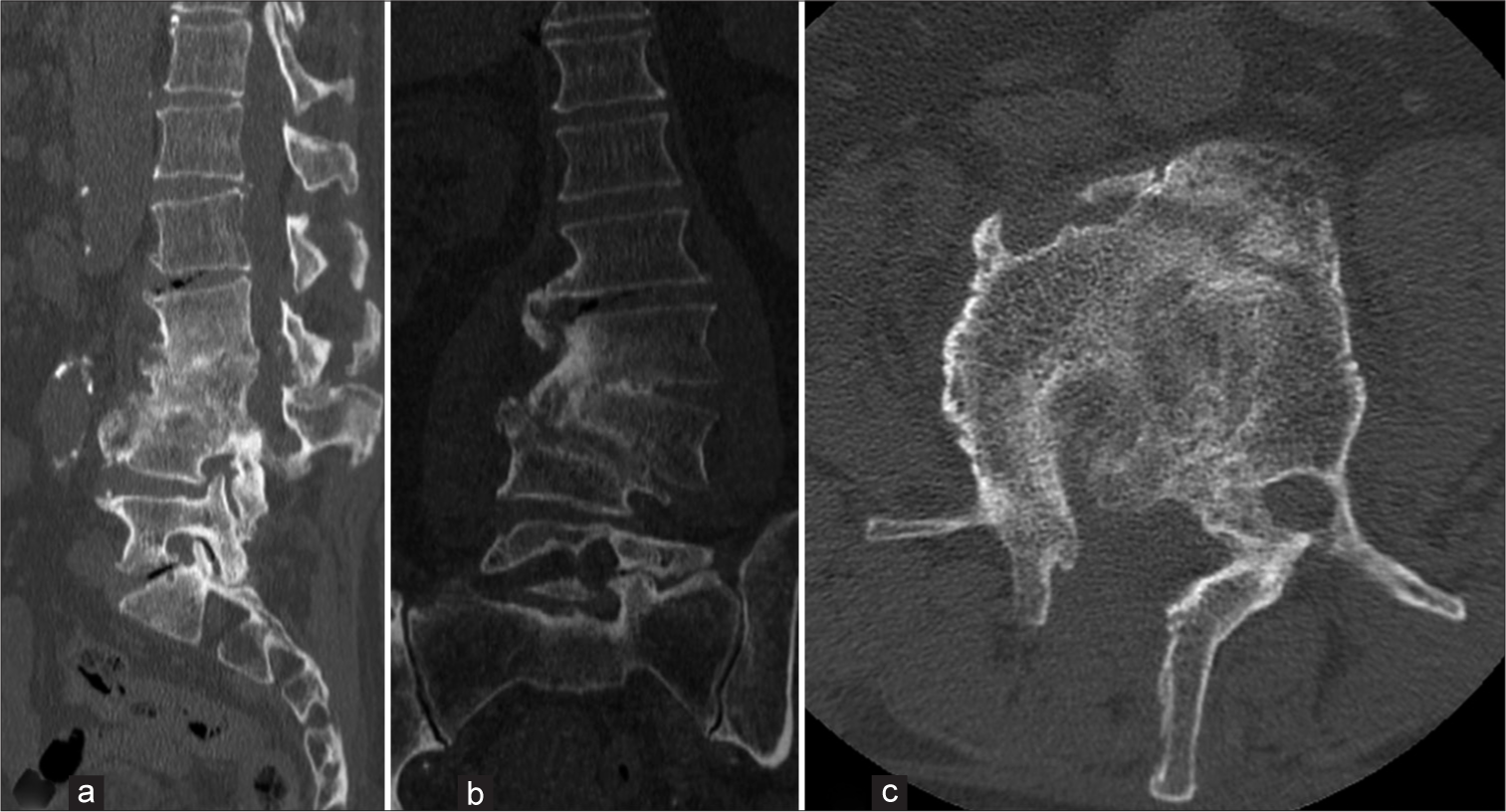 (a) Sagittal, (b) coronal, and (c) axial computed tomography scan images at 12 months follow-up, showing vertebral fusion of L2-L3-L4.