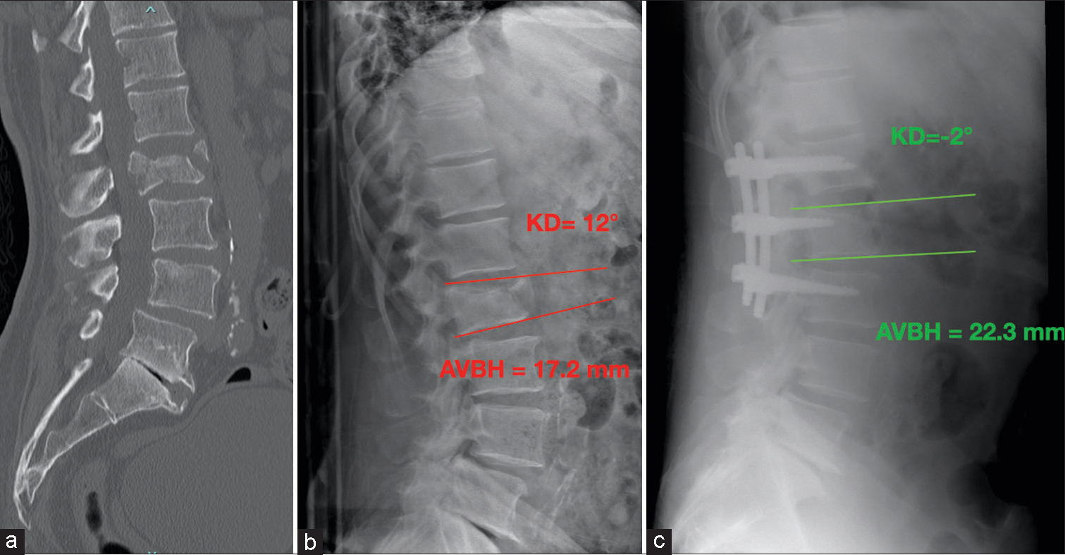 An exemplary case of a male 57-year-old patient belonging to Group B: (a) Sagittal view of thoracolumbar spine computer tomography scan with L2 A4 fracture. (b) Pre-operative lateral view spinal X-ray and an angular kyphosis of 14°, SI = 22. (c) Post-operative lateral view spine X-ray images showing 13° kyphotic deformity improvement. KD: Kyphotic deformity, AVBH: Anterior vertebral body height