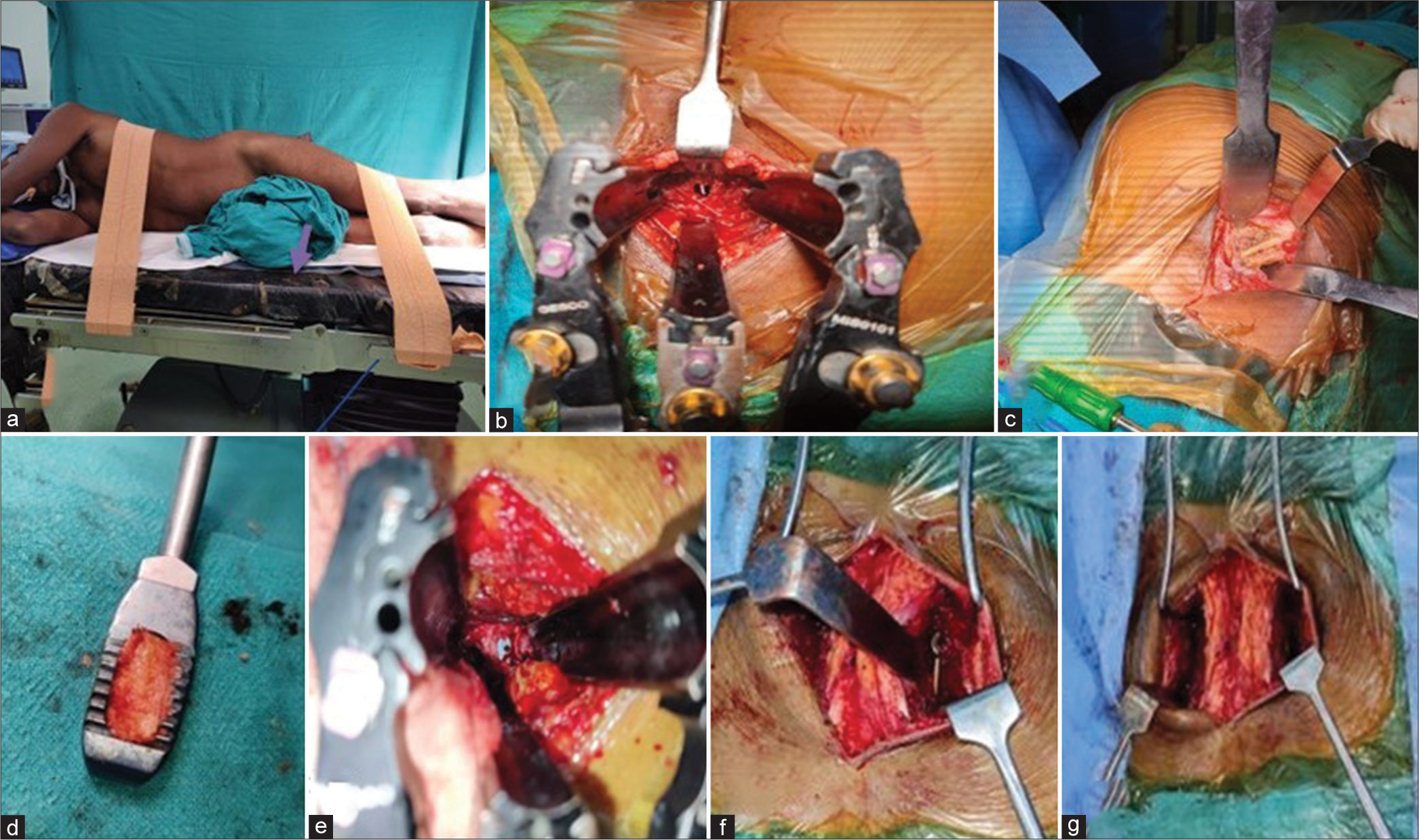 Steps of the Wiltse oblique lateral inetrbody fusion. a-the right lateral positioning; b-self-retaining retractors showing the disc space; c-the harvest of iliac crest graft;d-e-preparation and insertion of cage, f and g- insertion of pedicle screws by Wiltse approach).